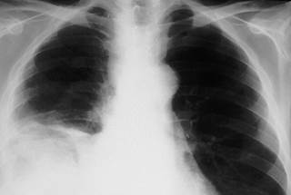 X-ray showing malignant mesothelioma / Science Source X-ray showing malignant mesothelioma / Science Source