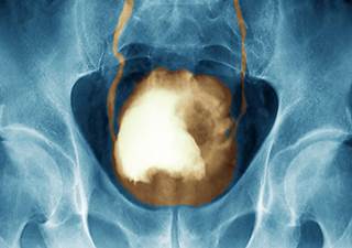 This study was designed to evaluate the efficacy of each treatment using 3-year distant metastasis–free survival as a primary outcome. This study was designed to evaluate the efficacy of each treatment using 3-year distant metastasis–free survival as a primary outcome.