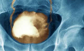 For Patients With Bladder Cancer, Inadequate Biopsies May Increase 5-Year Mortality For Patients With Bladder Cancer, Inadequate Biopsies May Increase 5-Year Mortality
