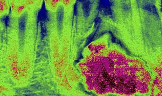 Researchers Find Way to Predict Oral Cancer Aggressiveness Researchers Find Way to Predict Oral Cancer Aggressiveness