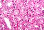 Urologic Cancer Risk Higher in Kidney Failure Patients Urologic Cancer Risk Higher in Kidney Failure Patients