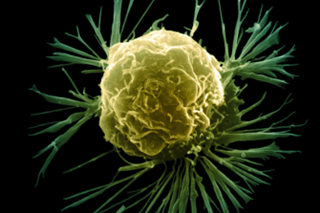 High-Fat Diet Ups Risk for Certain Breast Cancers High-Fat Diet Ups Risk for Certain Breast Cancers