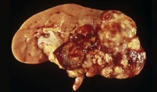 Study findings suggest that BET inhibitors might be a promising avenue of drug-development against RCC. Study findings suggest that BET inhibitors might be a promising avenue of drug-development against RCC.