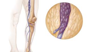 Presence of residual vein thrombosis in cancer patients may help determine the optimal duration of LMWH treatment. Presence of residual vein thrombosis in cancer patients may help determine the optimal duration of LMWH treatment.