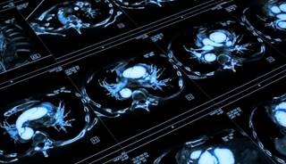 USPSTF: Screen High-Risk Adults for Lung Cancer USPSTF: Screen High-Risk Adults for Lung Cancer