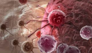 Cancer of Unknown Primary: Molecular Profiling May Direct Treatment Cancer of Unknown Primary: Molecular Profiling May Direct Treatment