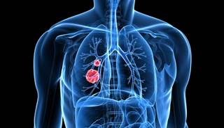 Genotype-directed Afatinib Ups Overall Survival in Some Lung Cancers Genotype-directed Afatinib Ups Overall Survival in Some Lung Cancers