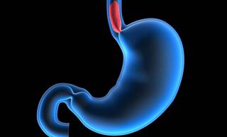 Induction Chemotherapy to Downstage Advanced Oesophageal Cancer Before Surgery Induction Chemotherapy to Downstage Advanced Oesophageal Cancer Before Surgery