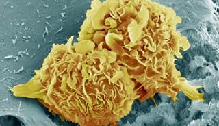 Overview of bone cancer as well as information on symptoms, diagnosis, and treatment. Overview of bone cancer as well as information on symptoms, diagnosis, and treatment.
