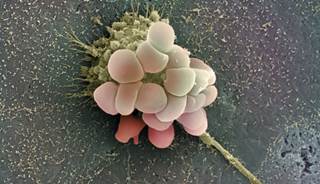 Findings among older patients with terminal ovarian cancer receiving hospice care. Findings among older patients with terminal ovarian cancer receiving hospice care.