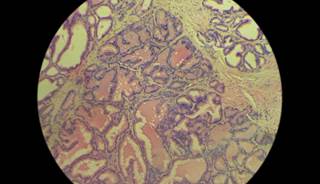 A biomarker panel was shown to be a surrogate for survival in patients with metastatic castration-resistant prostate cancer. A biomarker panel was shown to be a surrogate for survival in patients with metastatic castration-resistant prostate cancer.