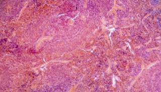 Chronic Pancreatitis Ups Cancer Mortality Risk Chronic Pancreatitis Ups Cancer Mortality Risk