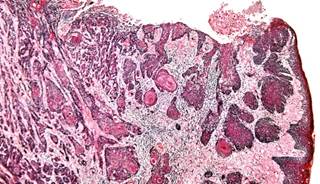 Obesity Increases Risk of Death From Tongue Cancer Obesity Increases Risk of Death From Tongue Cancer