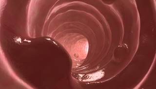 Colon Polyps More Likely in Obese Men Colon Polyps More Likely in Obese Men