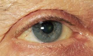 Selumetinib Has Modest Benefits in Eye Cancer Selumetinib Has Modest Benefits in Eye Cancer