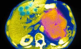Dipeptidyl-Peptidase-4 Inhibitors Shown Not to Increase Short-Term Risk of Pancreatic Cancer Dipeptidyl-Peptidase-4 Inhibitors Shown Not to Increase Short-Term Risk of Pancreatic Cancer