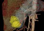 Pembrolizumab Did Not Improve PFS or OS Compared With Paclitaxel in Relapsed Gastric or Gastroesophageal Junction Cancer Pembrolizumab Did Not Improve PFS or OS Compared With Paclitaxel in Relapsed Gastric or Gastroesophageal Junction Cancer