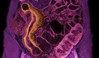Crohn's Disease and Cancer Risk Crohn's Disease and Cancer Risk