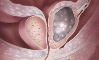 For Patients with Metastatic Castration-Resistant Prostate Cancer, Abiraterone Delays Disease Progression For Patients with Metastatic Castration-Resistant Prostate Cancer, Abiraterone Delays Disease Progression