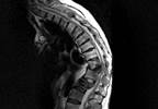 New Support for Single-dose Repeat Radiotherapy for Painful Bone Metastases New Support for Single-dose Repeat Radiotherapy for Painful Bone Metastases
