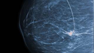 Study Refutes Long-held Assumption of Histologic Precursors of Breast Cancer Study Refutes Long-held Assumption of Histologic Precursors of Breast Cancer