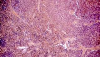 CT Scans Provide Info on Gemcitabine Response CT Scans Provide Info on Gemcitabine Response