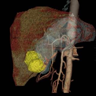 Docetaxel plus cisplatin and fluorouracil chemotherapy may be a viable option for patients with resectable gastric cancer. Docetaxel plus cisplatin and fluorouracil chemotherapy may be a viable option for patients with resectable gastric cancer.