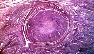 Excessive Uterine Leiomyosarcoma Dissemination Risk During Uterine Morcellation Excessive Uterine Leiomyosarcoma Dissemination Risk During Uterine Morcellation