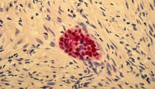 Safe to Postpone ADT in Men with Asymptomatic Prostate Cancer and Rising PSA Levels Safe to Postpone ADT in Men with Asymptomatic Prostate Cancer and Rising PSA Levels