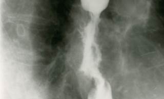 Similar improvement in dysphagia for radiotherapy alone, chemoradiotherapy. Similar improvement in dysphagia for radiotherapy alone, chemoradiotherapy.