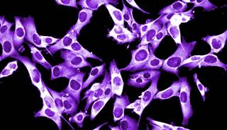 AACR: ICMgp100 Promising for Advanced Melanoma AACR: ICMgp100 Promising for Advanced Melanoma