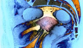 Bariatric Surgery May Help Prevent Endometrial Cancer Bariatric Surgery May Help Prevent Endometrial Cancer