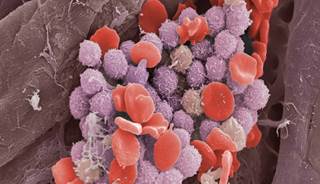 Idelalisib Plus Rituximab Highly Effective for Relapsed CLL Idelalisib Plus Rituximab Highly Effective for Relapsed CLL