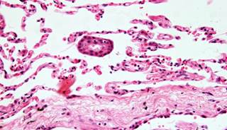 Younger Patients With a History of Skin Cancer Who Smoke Are More Likely to Develop Extra-Cutaneous Younger Patients With a History of Skin Cancer Who Smoke Are More Likely to Develop Extra-Cutaneous