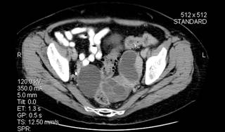 Veliparib May Benefit Women With Treatment-resistant Gynecologic Cancers Veliparib May Benefit Women With Treatment-resistant Gynecologic Cancers