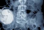 Low-dose Morphine More Effective in Treating Moderate Cancer Pain Low-dose Morphine More Effective in Treating Moderate Cancer Pain