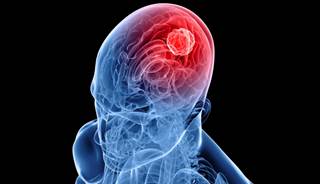 Intra-arterial Chemo Beneficial for Recurrent Glioblastoma Intra-arterial Chemo Beneficial for Recurrent Glioblastoma