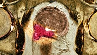 Chronic Inflammation More Common in Aggressive Prostate Cancer Chronic Inflammation More Common in Aggressive Prostate Cancer