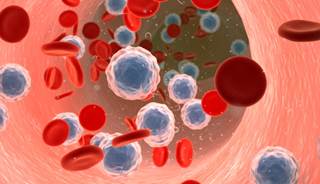 New Drug May Be Game-Changer for AML New Drug May Be Game-Changer for AML
