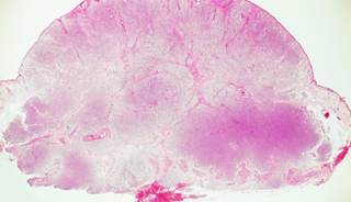 Study Pinpoints Outcome Predictors in Merkel Cell Carcinoma Study Pinpoints Outcome Predictors in Merkel Cell Carcinoma