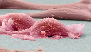 Doxorubicin plus trabectedin have activity as first-line treatment for uterine leiomyosarcoma and soft-tissue leiomyosarcoma. Doxorubicin plus trabectedin have activity as first-line treatment for uterine leiomyosarcoma and soft-tissue leiomyosarcoma.