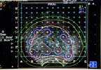 Low-Dose Brachytherapy Improves Disease-Free Survival in Unfavorable-Risk Prostate Cancer Low-Dose Brachytherapy Improves Disease-Free Survival in Unfavorable-Risk Prostate Cancer