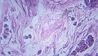 Obesity Ups Mortality in Premenopausal ER+ Breast Cancer Obesity Ups Mortality in Premenopausal ER+ Breast Cancer