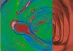 Secondary Colorectal Cancer Tied to Radiation-treated Cervical Cancer Secondary Colorectal Cancer Tied to Radiation-treated Cervical Cancer
