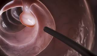 Colonoscopy Benefits Unscreened Elderly Patients Colonoscopy Benefits Unscreened Elderly Patients