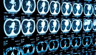 CMS Recommends Against Low-Dose CT Lung Cancer Screening CMS Recommends Against Low-Dose CT Lung Cancer Screening