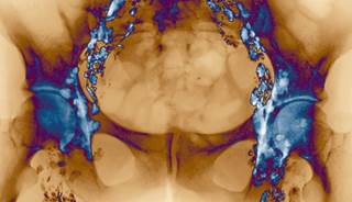 Nivolumab Designated Breakthrough Therapy for Hodgkin Lymphoma Nivolumab Designated Breakthrough Therapy for Hodgkin Lymphoma