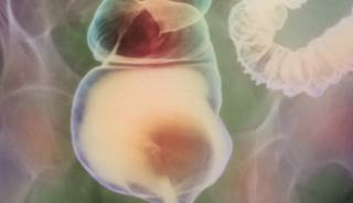 Irritable Bowel Syndrome and Colorectal Cancer Irritable Bowel Syndrome and Colorectal Cancer