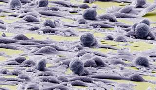 Dasatinib may have activity in patients with undifferentiated pleomorphic sarcoma but is not an effective monotherapy for other sarcoma types. Dasatinib may have activity in patients with undifferentiated pleomorphic sarcoma but is not an effective monotherapy for other sarcoma types.