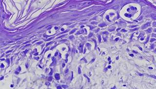 Mogamulizumab Offers Glimmer of Hope for Relapsed T-cell Lymphomas Mogamulizumab Offers Glimmer of Hope for Relapsed T-cell Lymphomas